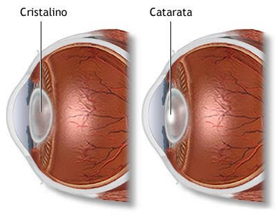 Cataract Surgery